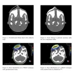 Bolus in radiotherapy